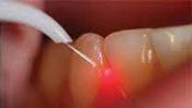 closeup of laser work being done on teeth